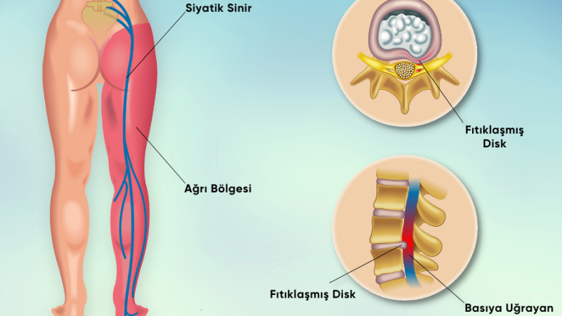 Bacağa vuran bel fıtığı ağrısına dikkat!